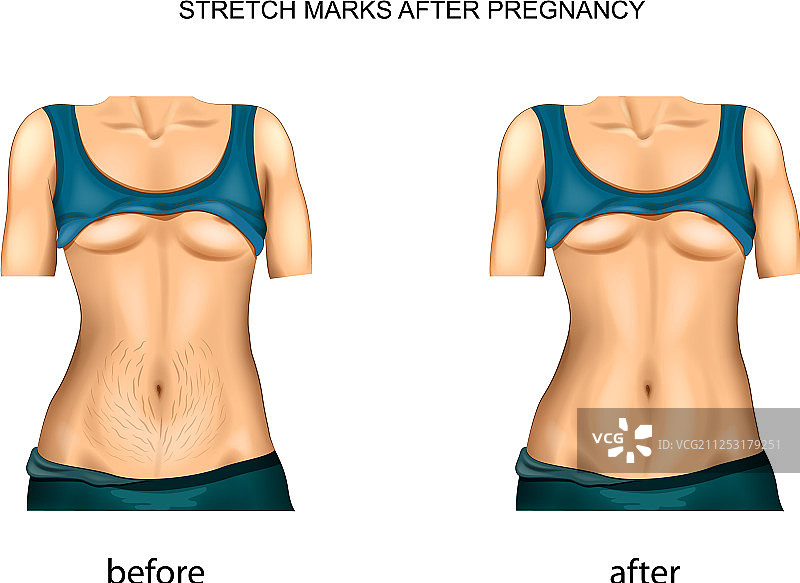 妊娠纹修复前后对比图片素材
