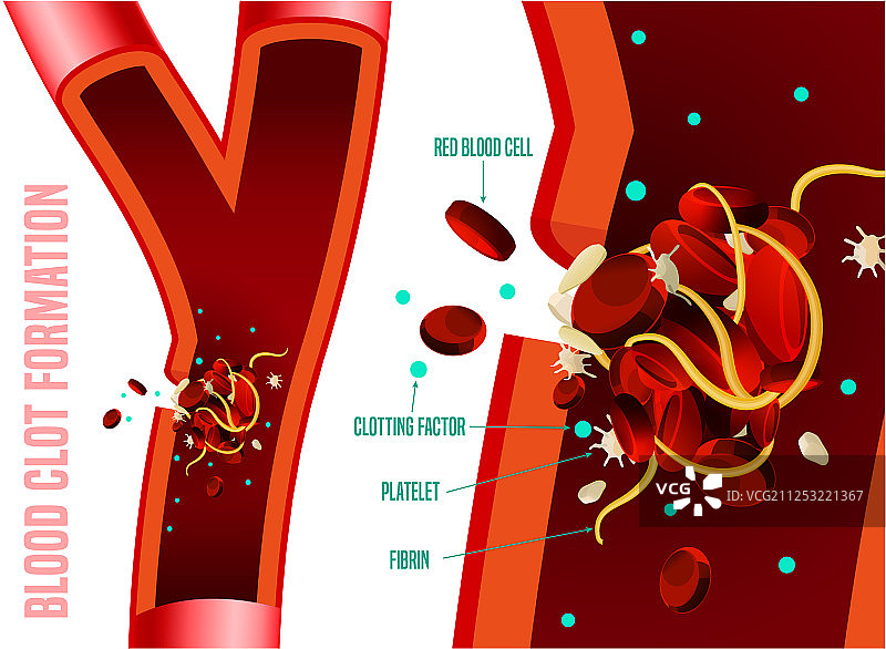 血栓形成图片素材