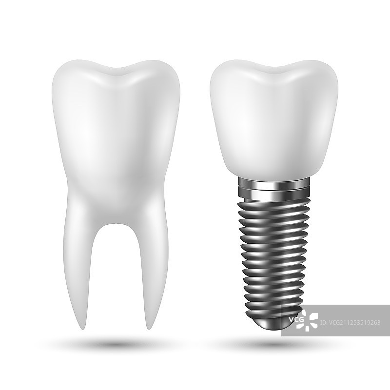 3D逼真白色牙齿植入体渲染图片素材