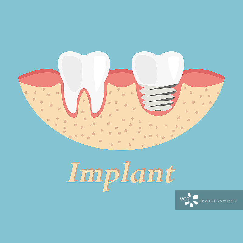 牙齿种植修复过程图片素材