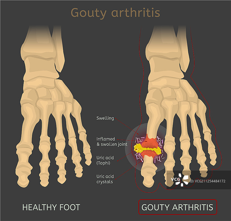 痛风性关节炎图像图片素材