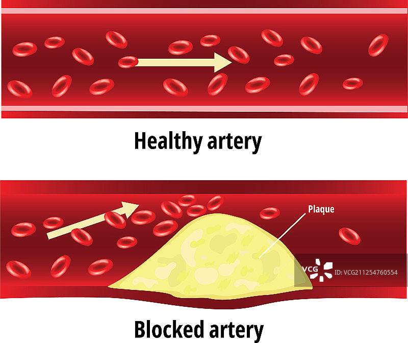 阻塞的动脉血管脂肪图片素材