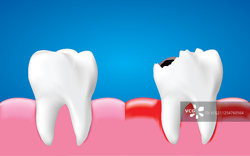 发炎的龋齿和健康的牙齿图片素材