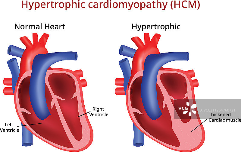 肥厚型心肌病图图片素材
