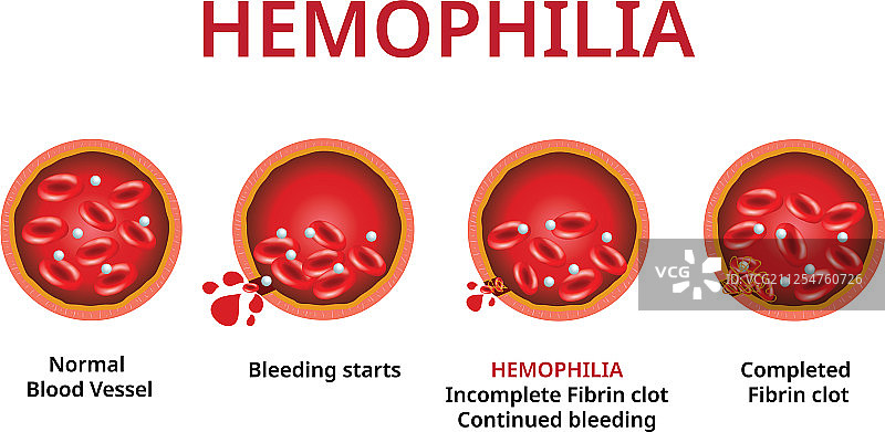 血友病损毁的血管图片素材