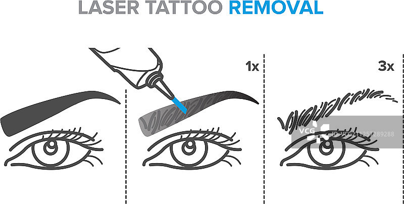 激光永久去除眉毛图片素材