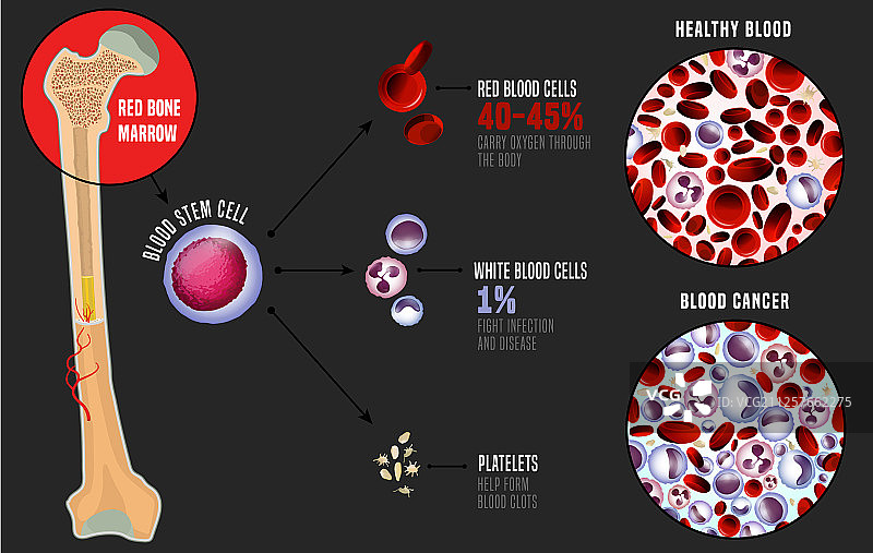 白血病医学信息图图片素材