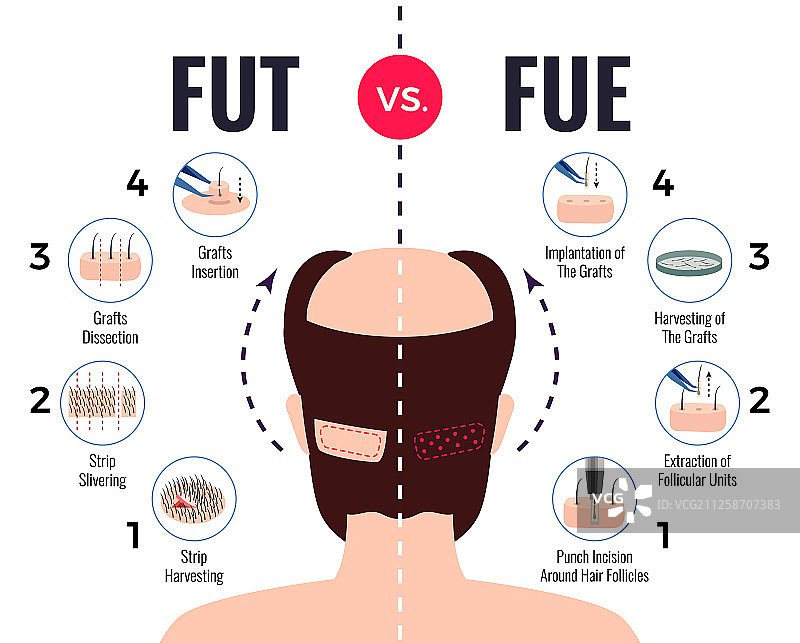 头发移植：FUT与FUE图片素材