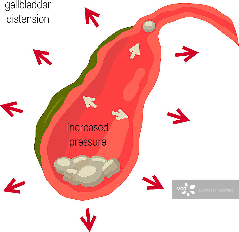 胆囊胆结石炎症概念图片素材