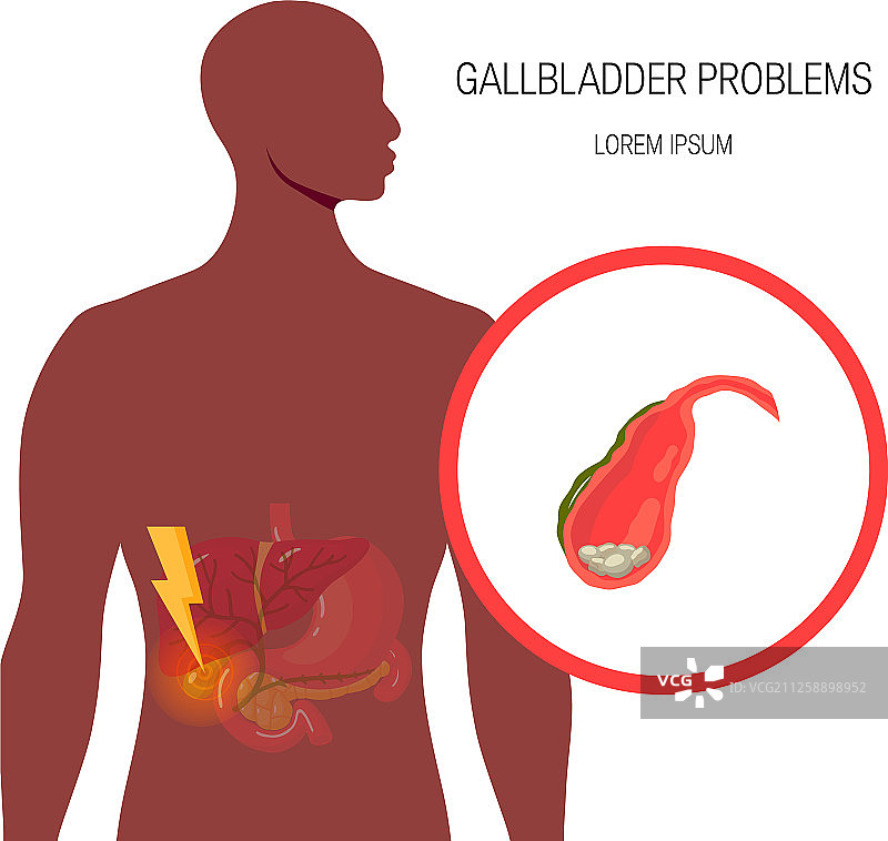 胆管医学示意图片素材