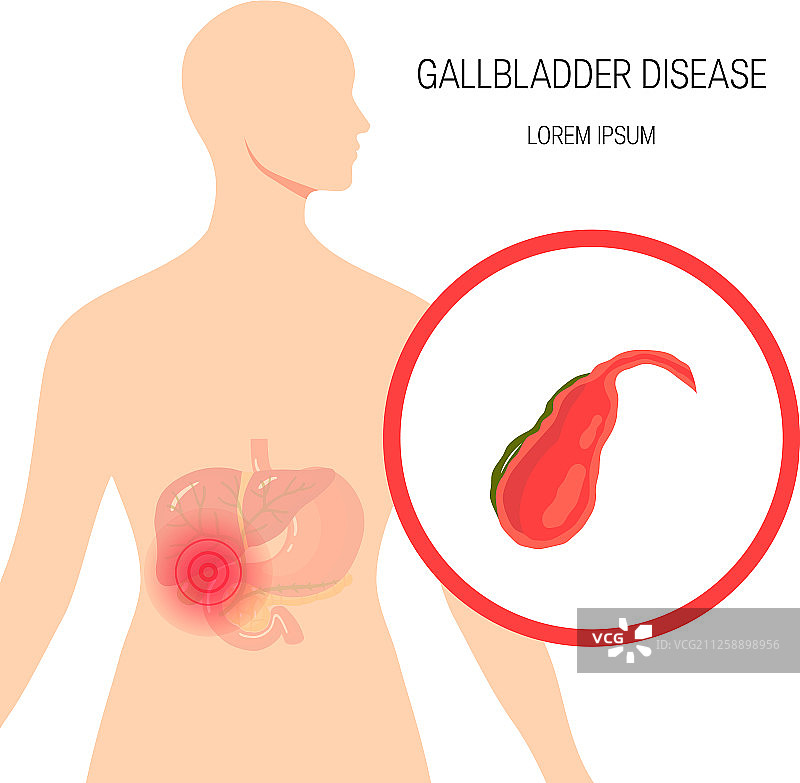 胆管医学示意图片素材