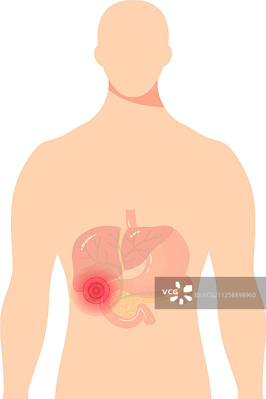 胆管医学示意图片素材
