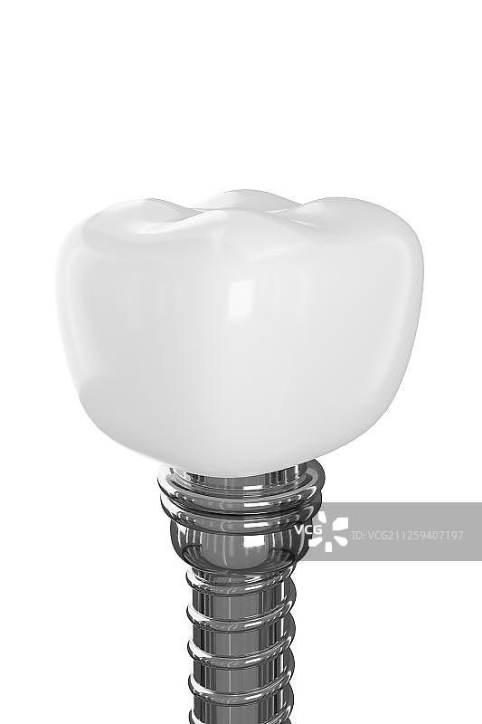 3D种植牙图片素材