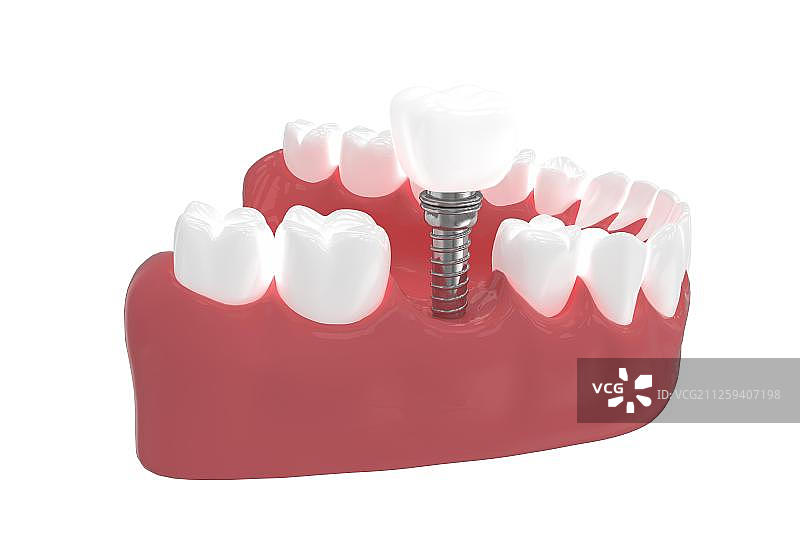 3D种植牙图片素材