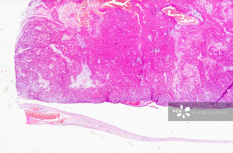 生物病理显微镜切片纤维肉瘤标本白底显微摄影教学素材图片素材