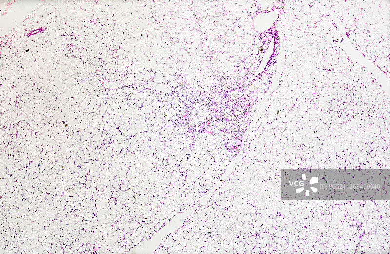 生物病理显微镜切片脂肪肉瘤标本白底显微摄影教学素材图片素材