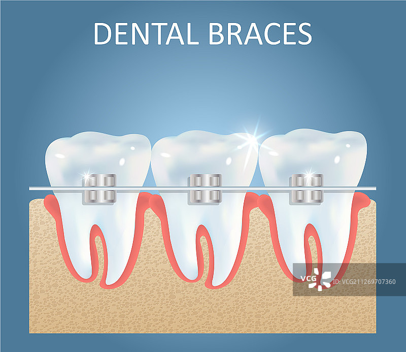 牙齿矫正医疗海报设计图片素材