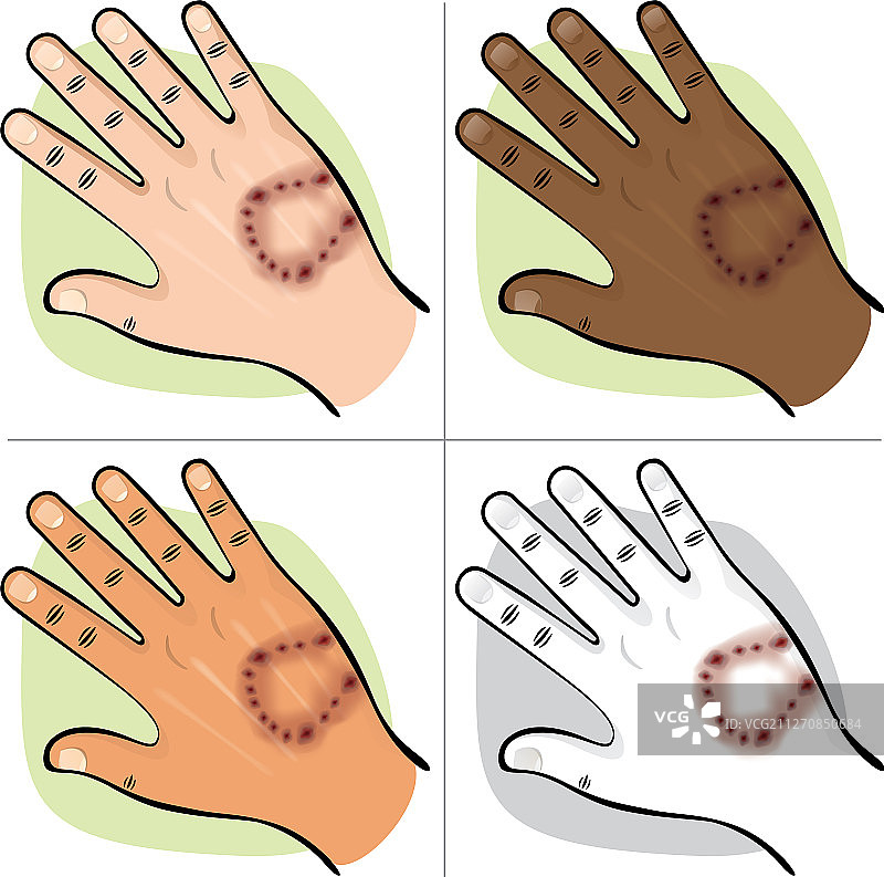 被动物咬伤的手图片素材