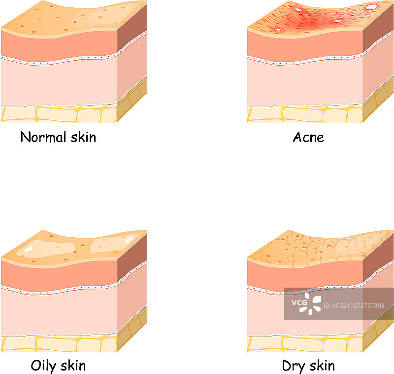 正常、干燥和油性痤疮皮肤问题图片素材
