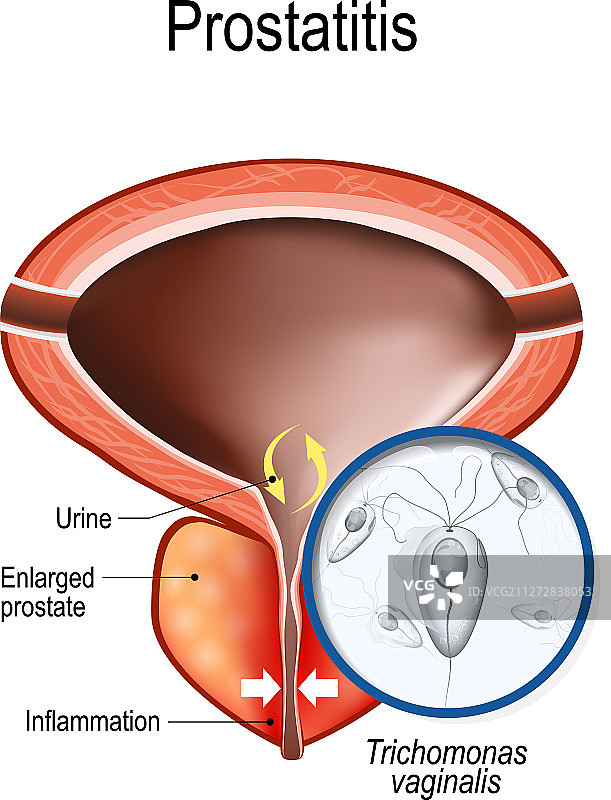 前列腺炎与阴道毛滴虫图片素材