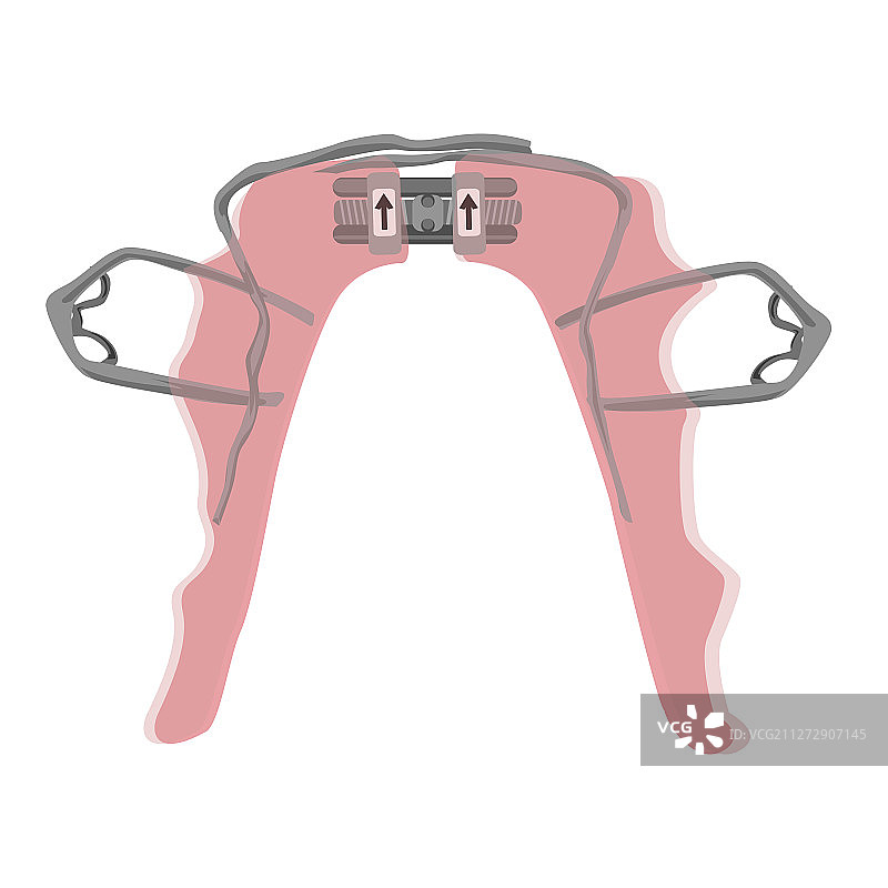 用于治疗下颌的腭扩张器图片素材