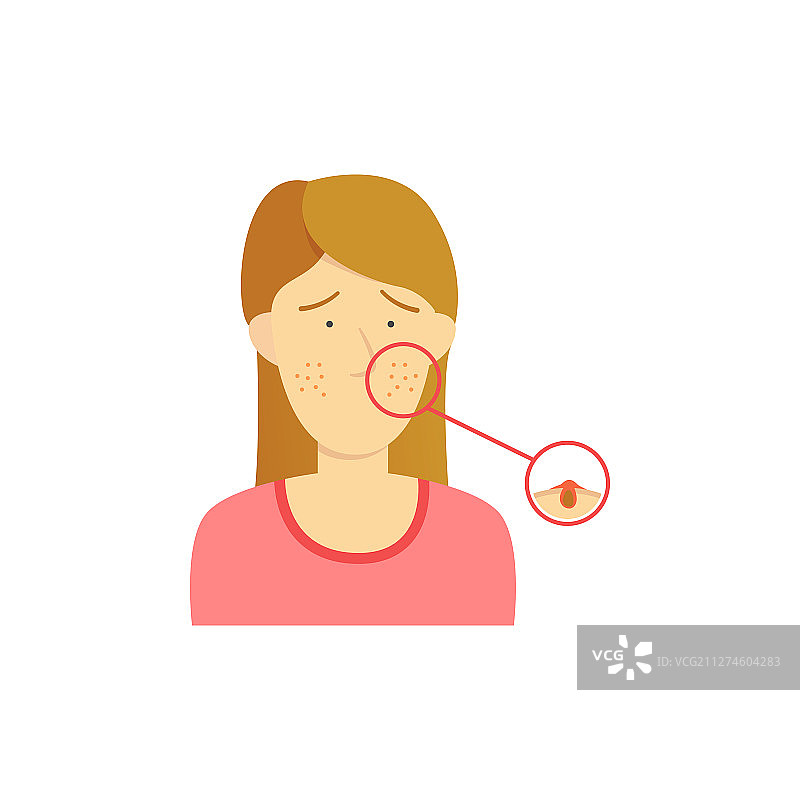 棕色头发的痤疮女孩图解图片素材