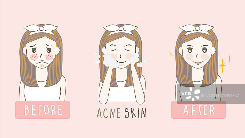 女性面部痤疮皮肤护理前后图片素材