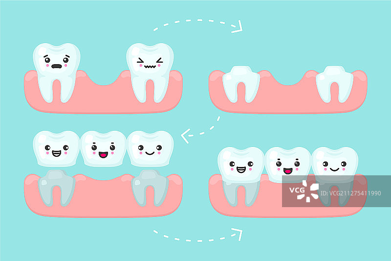 牙科桥梁修复牙齿图片素材