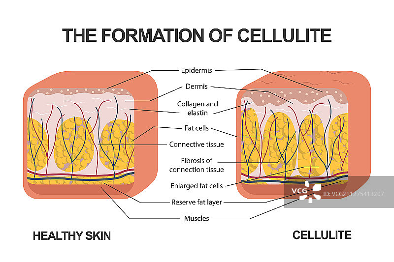 脂肪团的形成图片素材