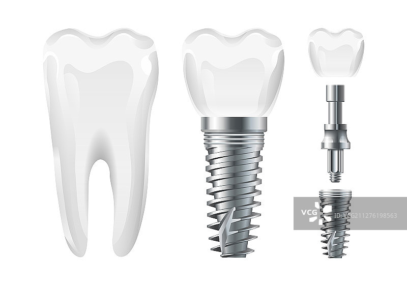 牙科手术种植牙切口和健康牙齿图片素材