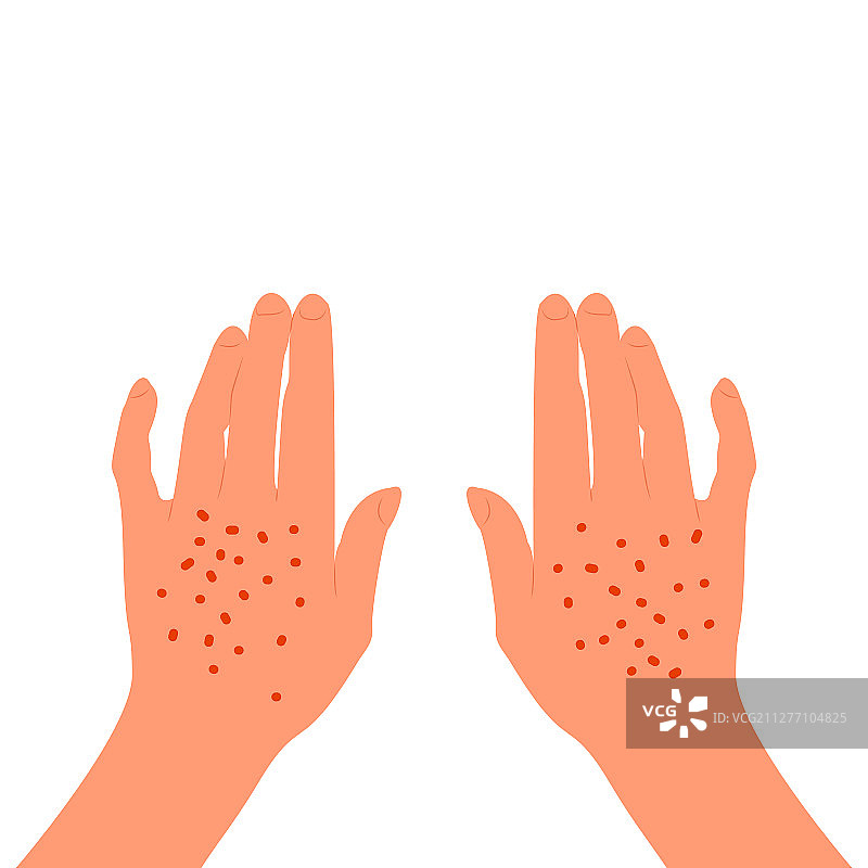 女性背部皮肤上的红色皮疹图片素材