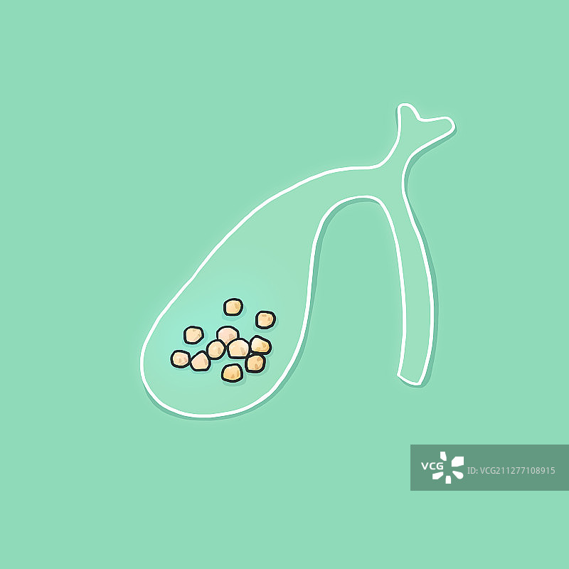 胆结石图片素材