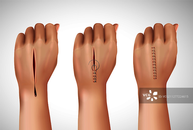 外科缝合线迹逼真组合，包含人手在不同缝合阶段的孤立图像矢量图图片素材