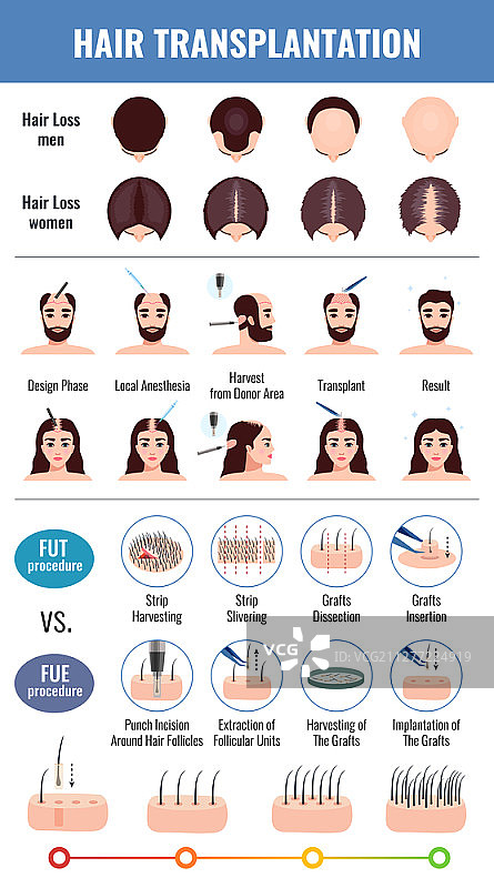 男女脱发与植发方法信息图图片素材