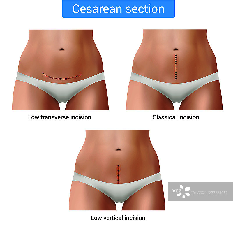 逼真的外科缝合线与女性身体素材矢量图图片素材