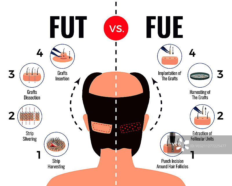 头发移植方法：FUT vs FUE海报，白色背景矢量图图片素材
