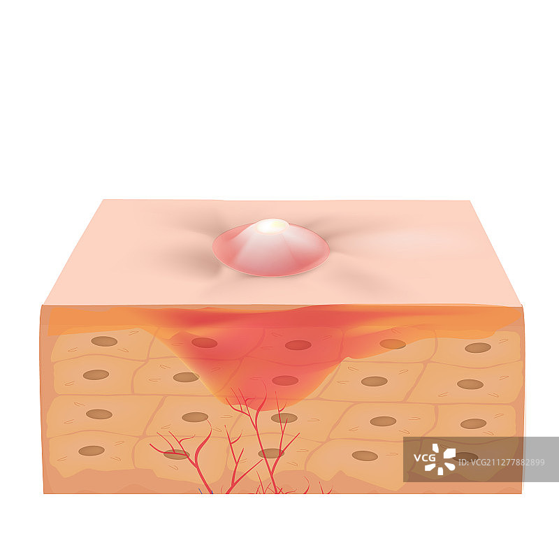 皮肤上的发炎痤疮图片素材