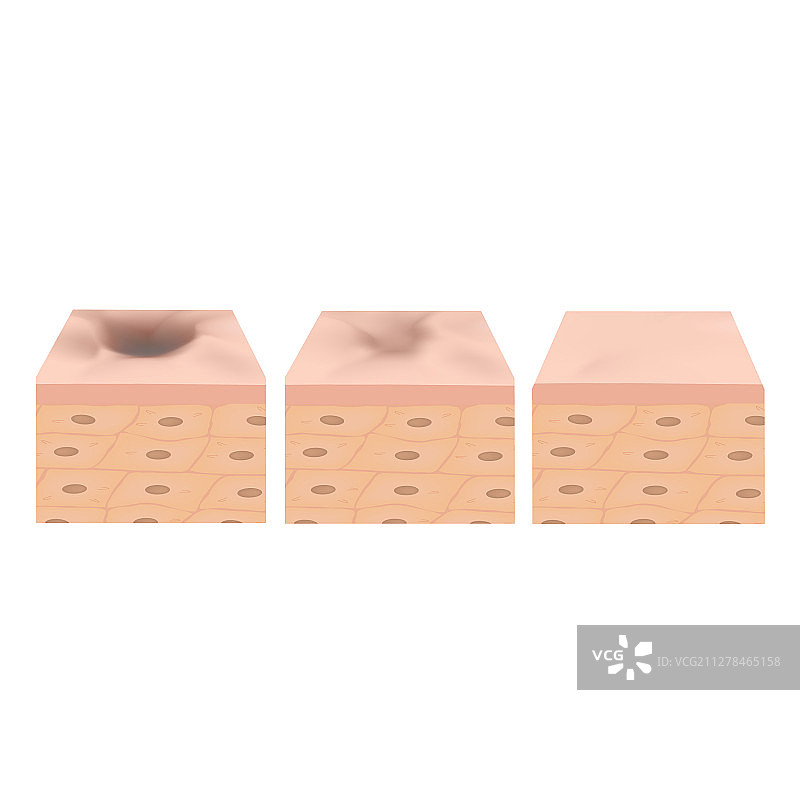 萎缩性痤疮疤痕治疗图片素材