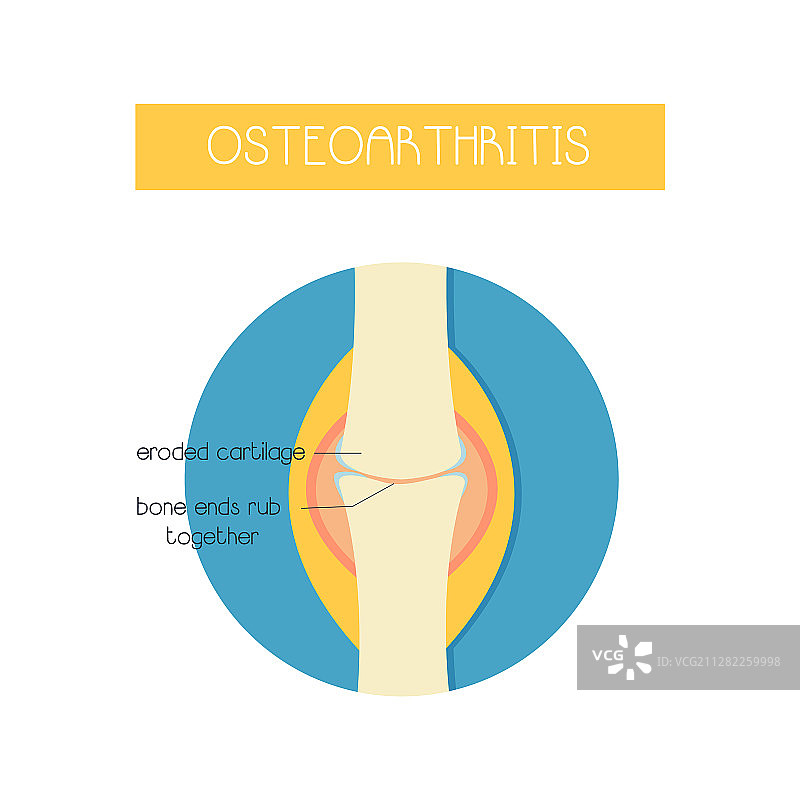 患有骨关节炎的骨头图片素材