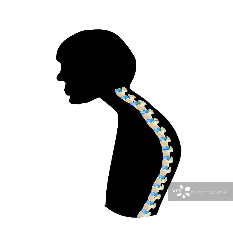 脊柱后凸图片素材