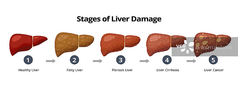 健康脂肪肝引起的肝损伤阶段图片素材