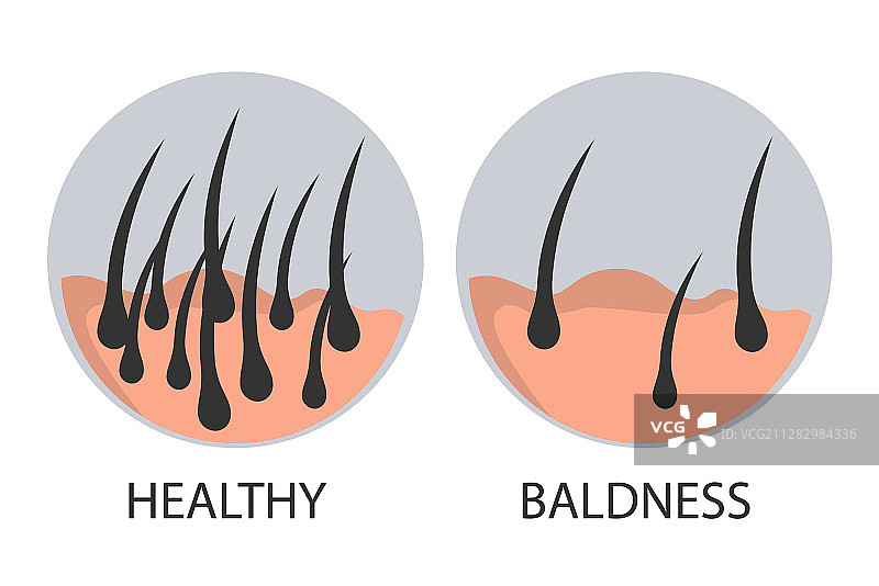 脱发前后阶段示意图图片素材
