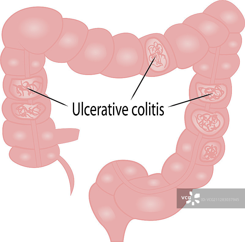 溃疡性结肠炎肠道疾病图片素材