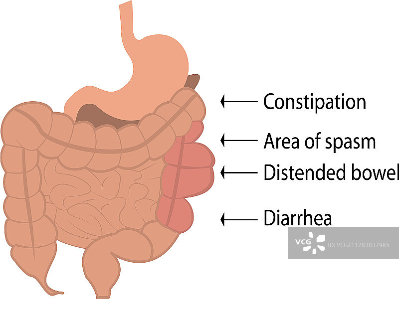 肠易激综合征图片素材