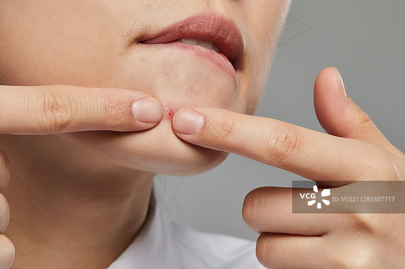 人体皮肤，皮肤病学，美容，痤疮图片素材