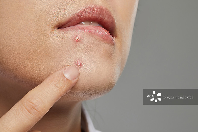 人体皮肤，皮肤病学，美容，痤疮图片素材