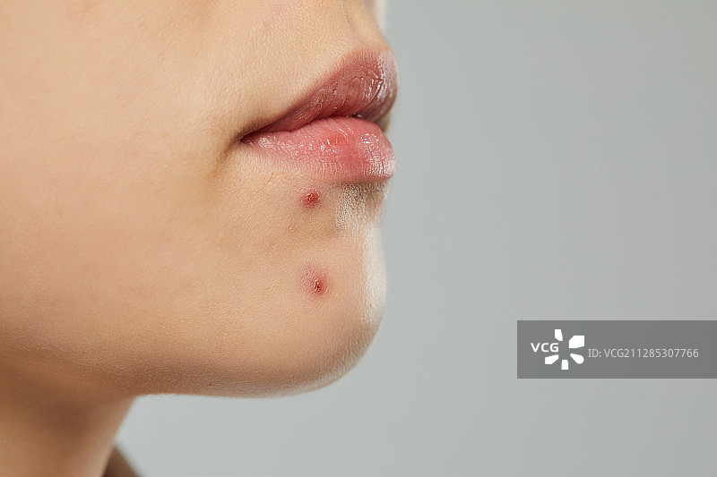 人体皮肤，皮肤病学，美容，痤疮图片素材