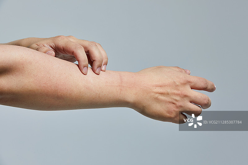 特应性皮炎，皮炎，皮肤问题，皮肤瘙痒，皮肤科图片素材