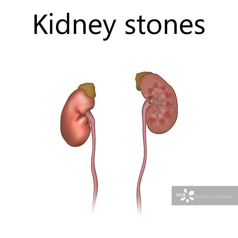 肾结石插图图片素材