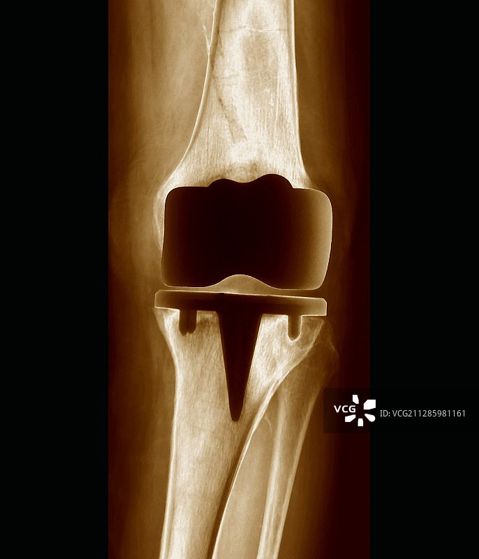 假体膝关节X光片图片素材